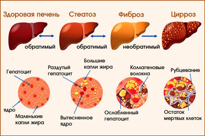 cirroz-pecheni5.jpg